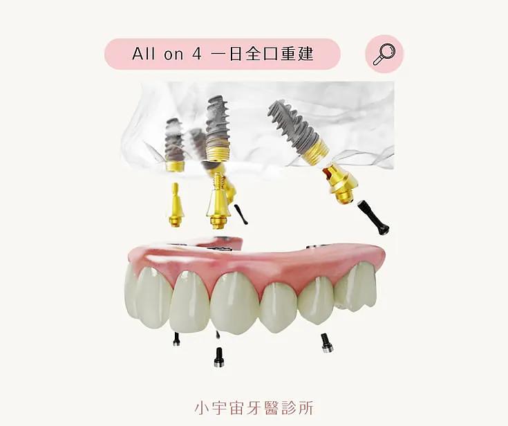 All on 4 一日全口重建